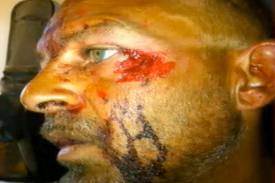 Victim of alleged cannibal attack fought off his assailant with a can of wasp poison