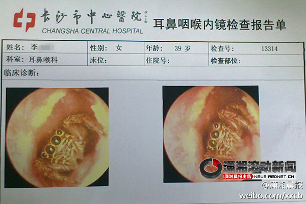 Spider Found Living In Woman's Ear Canal Spider Found Living In Woman's Ear Canal