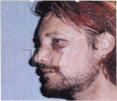 gabriel-aubry-fight-injuries-03-480w