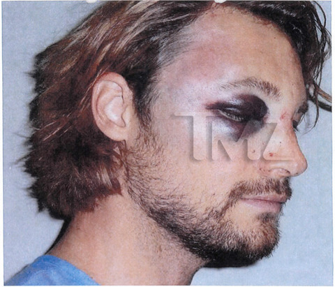 gabriel-aubry-fight-injuries-05-480w